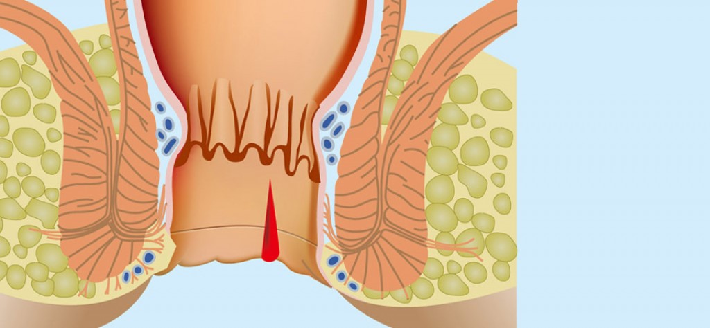 MICROCHIRURGIA LASER PER LE RAGADI